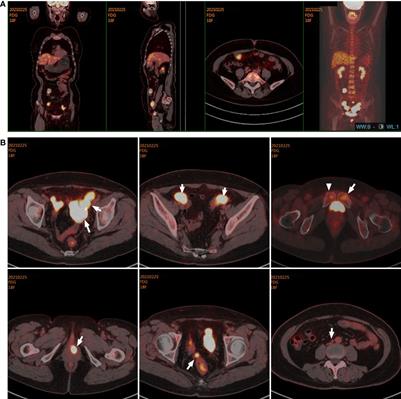 Case Report: Clinical response to anaplastic lymphoma kinase inhibitor-based targeted therapy in uterine inflammatory myofibroblastic tumor harboring ALK-IGFBP5 fusion